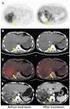 PROGNOSTIC IMPORTANCE OF SUV MAX VALUE IN PET/CT AND CORRELATION SUV MAX VALUE BETWEEN LYMPH NODE, DISTANT METASTASIS IN NON SMALL CELL LUNG CANCER