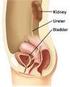 Obesity and Stress Urinary Incontinence in Women