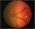 Prematüre retinopatisi gelişen olgularda risk faktörlerinin değerlendirilmesi