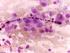 Küçük Hücreli Akciğer Kanserine Bağlı Paraneoblastik Sendrom Olgusu
