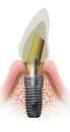 Dental İmplantlarda Stabilite Ölçüm Yöntemleri