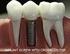 MODE DENTAL IMPLANT SYSTEM Titanium Made in USA