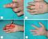 Cross-Finger Adipofasyal Flep ile Komplike Parmak Defektlerinin Onarımı