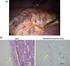 Surgical Treatment of Hemoptysis: Analysis of 17 Cases. Hemoptizide Cerrahi Tedavi:17 Olgunun Analizi. n i. j O. r l