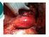 Sonuç: Torakoabdominal aort anevrizması ve diseksiyonlarının. distal femoro-femoral perfüzyon tekniğiyle cerrahi onarımı