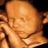 Üç-dört haftal k bebeklerde yürütülen ultrasonografik kalça taramas program nda üç y ll k deneyimimiz