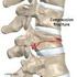 Vertebra kompresyon kırıklarında perkütan vertebroplasti uygulamalarımız