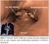 Pnömonektomi Sonrası Erken veya Geç Bronkoplevral Fistülde Transsternal- Transperikardiyal Kapatma