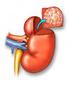 Açık Radikal Nefrektomi ve Açık Nefron Koruyucu Cerrahi