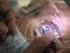Fakoemülsifikasyon Cerrahisi Sonrası Erken Dönem Göz İçi Basıncı Kontrolünde Oral ve Topikal Karbonik Anhidraz İnhibitörlerinin Etkinliği