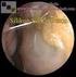 Nazal septal perforasyon, nazal septumu oluşturan mukoza, kemik. Mukozal Rotasyon Flep Tekniği ile Nazal Septal Perforasyon Tamiri Sonuçları