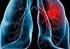Akciğer kanseri, günümüzde hâlâ kansere bağlı ölümlerin en sık sebebi olarak