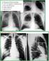 Akciğer Kanseri Tanısında Konvansiyonel Radyografi ve Bilgisayarlı Tomografi Bulguları