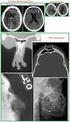 Orbital travmada radyolojik bulgular