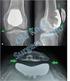 Patellofemoral artroz ve artroplasti