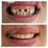 Zirkonyumla Güçlendirilmiş Seramikler ve Dental İmplantolojide Kullanımı