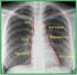 Kronik Obstrüktif Akciğer Hastalığında Yüksek Rezolüsyonlu Bilgisayarlı Tomografi Bulguları İle Solunum Fonksiyon Testleri Arasındaki Korelasyon