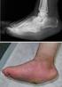 Diyabetik ayakta görüntüleme. Imaging of the diabetic foot. Z. Gamze Kılıçoğlu 1, Önder İ. Kılıçoğlu 2