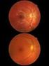 Retina Görüntülerinde Yaşa Bağlı Makula Dejenerasyonunun İstatistiksel Yöntemlerle Segmentasyonu
