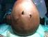 Penetrating injury of cranium: a case report