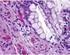 Key Words: Carcinoembriyonic antigen; Epithelial cells;hyperplasia, carcinoma, intraductal; Protein P53