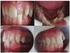 Evaluation of malocclusion and crowding in under orthodontic treatment