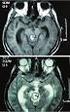 Spinal İntradural Tümörler. Cem Dinç, Celal Ahmet İplikçioğlu, Azmi Tufan, Erdinç Özek