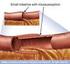 Legg-Calve Perthes hastalığında proksimal femoral varus osteotomisi sonuçları