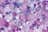 Non-Hodgkin Lenfomalı Hastalarda Kemik İliği ve Periferik Stem Cell Ürünlerinin İnterleukin-2 ye Cevaplarının Karşılaştırılması