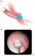 Vezikoüreteral reflü tedavisinde minimal invaziv cerrahi