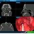 REVISION ENDOSCOPIC SINUS SURGERY