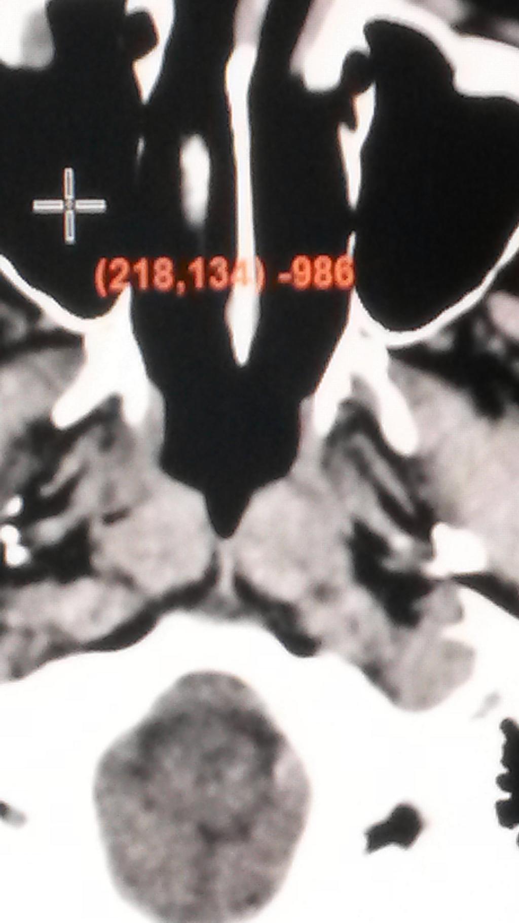 Tipik bir tomogra görüntü kesiti Beyin tomogra sinden bir görünüm(seçilen bir noktan n koordinat ve