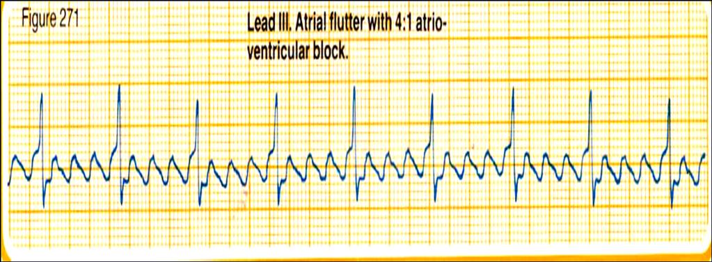 ATRİYAL FLATTER Özellikle DII, DIII, avf de görülen testere dişi i ğ e i şeklinde flatter dalgaları.