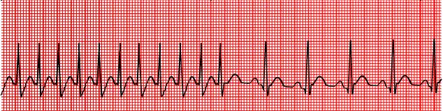 SUPRAVENTRİKÜLER TAŞİKARDİ AV nodda ve AV nod ile aksesuar yol arasında oluşan reentry mekanizmasıyla meydana gelir (AvnRT, AVRT) Atriyal hız 100 250 dir (çok sıklıkla 140 200) EKG