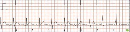 Wolf Parkinson White Sendromu Ekg Karakteristikleri: PR intervali < 120ms (kısa PR) Delta dalgası varlığı QRS > 100ms WPW Sendromunda Aritmiler: