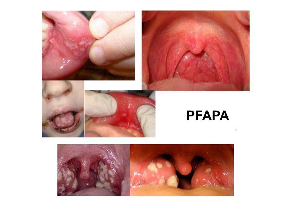 PFAPA SENDROMU periodic fever, aphthous stomatitis, pharyngitis, and cervical adenitis Periyodik ateş,