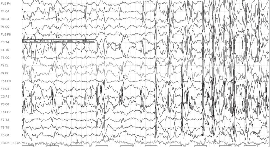 G. Bektaş ve ark., Çocukluk Çağının Sentrotemporal Dikenli Selim Epilepsisinde Tedavi Yaklaşımı ve Prognoz olarak normal EEG bulguları da saptanabilir (%3-35) (2).