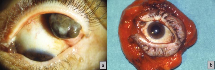 RESİM 3: a) 52 yaşında erkek hasta. Konjonktiva melanomu olgusunda göz kapağı ve orbita tutulumu mevcut (AJCC T3). b) Resim 3a daki olguda göz dışı ve orbital tümör yayılımı izlenmekte.