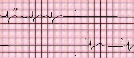 Hasta Sinüs Sendromu Taşikardi bradikardi sendromu EKG de; İlk üç