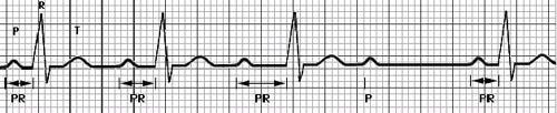 II. Derece Tip 1 AV Blok PR Aralığı: Değişken uzar ve bir P ye QRS yanıtı olmaz Atrial ritm; Düzenli Ventriküler ritm; Düzensiz QRS