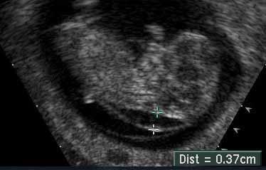 12 haftalık gebelikte ultrasonografide artmış ense kalınlığı. (Trizomy 21 Down Sendromu çıkmıştır.) İkili testin yaklaşık % 85-90 civarında belirleyicilik oranı vardır.