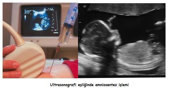 bebeğin bulunduğu amnion sıvısından 15-20 ml sıvı alınarak bebeğin bu sıvıya dökülen hücrelerin alınmasıdır.. En erken 16. haftada yapılabilinir. Daha erken yapılması (13-14.