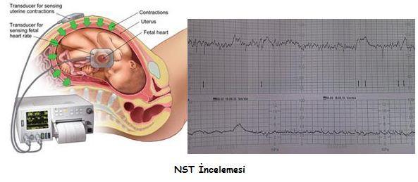 NST ile bebek kalp atımlarının çizelgesi yazdırılır ve ultrasonografi ile; bebek gelişimi, amnion sıvısı, bebek hareketleri ve tonusu, solunum hareketlerinin