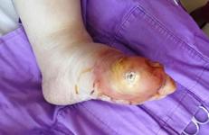 Konya P ve ark. / Diyabetik Ayak Enfeksiyonları Diyabetik ayak ülserleri ve takiben gelişen infeksiyonlar, Diabetes Mellitus lu (DM) hastalardaki en önemli komplikasyonlardan biridir.