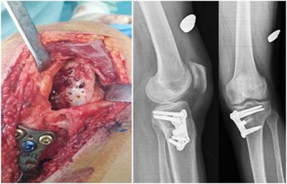 Konya MN et al./ High Tibial Osteotomi tients patella posterior cartilage were affected(outerbridge III and IV).