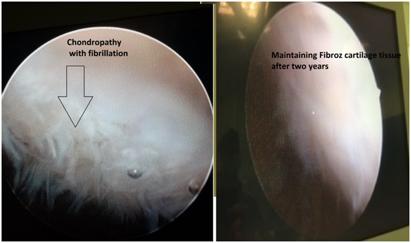 Konya MN et al./ High Tibial Osteotomi complex medial meniscus lesion and implant removal.