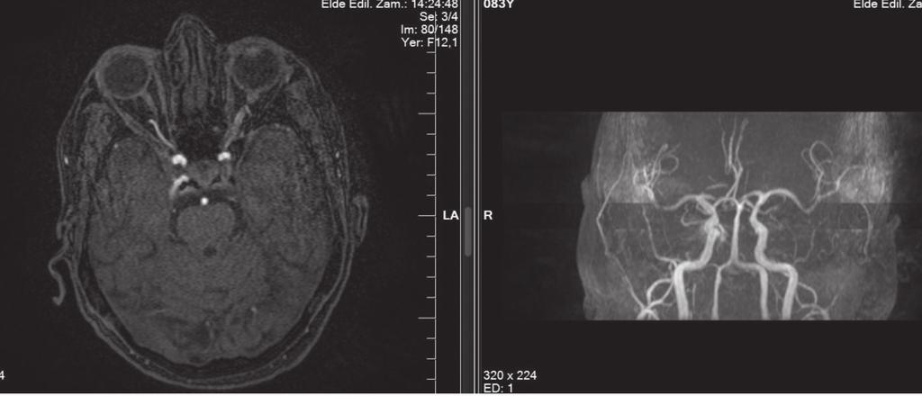 Resim 1: 3 D TOF slab sekansında,superior oftalmik vende dilatasyon ve kavernöz sinüste sinyal artışı Resim 2:Sağda kavernöz sinüs düzeyinde bilateral eksternal karotid arterin multipl meningeal
