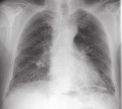 mesothelioma affects what part of the body