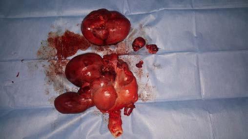 SS-023 Sağ kalbe uzanım gösteren uterin intravenöz leioyomyomatozis: nadir bir olgu sunumu Anahtar Kelimeler: leiomyomatozis, intrakardiyak, pelvik kitle, intrakardiyak kitle Batın içi kitle