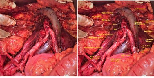 Standardize edilmiş paraaortik lenf nodu disseksiyonu, olası damar anomalilerinin farkedilip korunmasını sağlayabilir ve istenmeden oluşabilecek damar hasar oranını azaltabilir.
